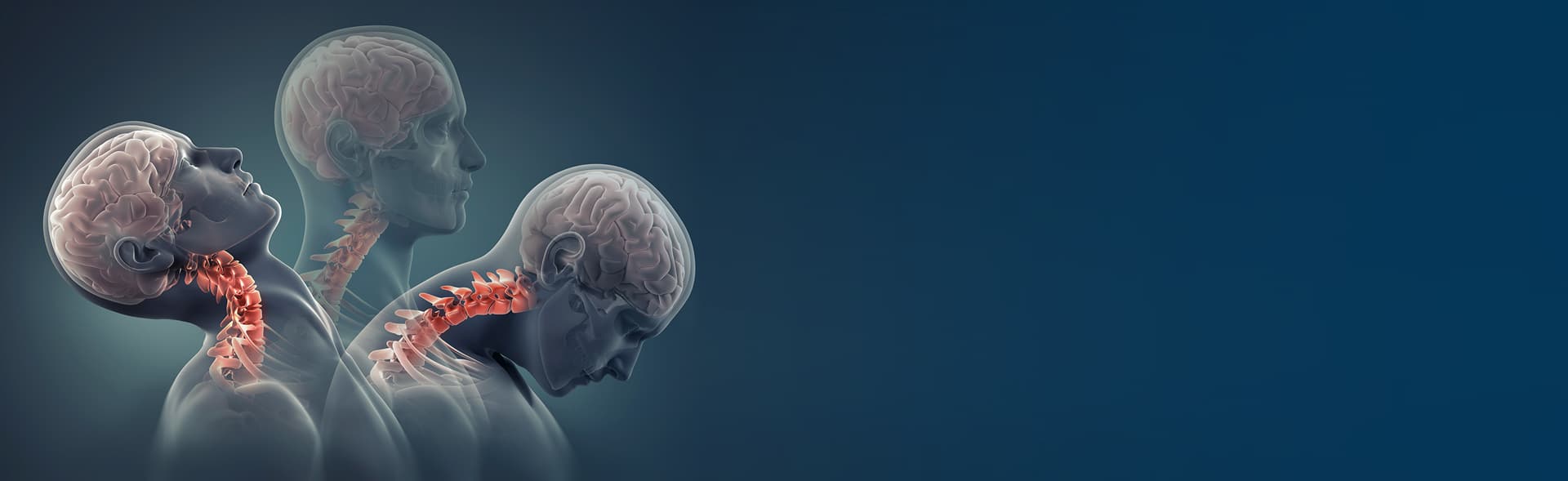 Illustration of the head and neck moving through a whiplash motion